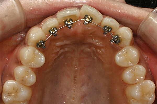 Lingual braces